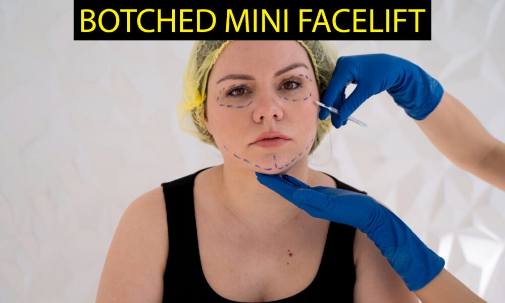 Botched Mini Facelift