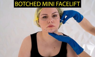 Botched Mini Facelift