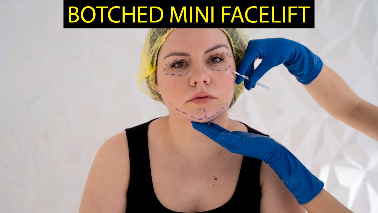 Botched Mini Facelift